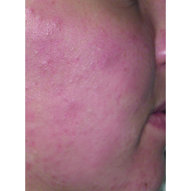 Spray Antiac, fata si corp,  pt. curatarea pielii congestionate cu acnee, Omega, vitamina A, E, Salcura 100 ml