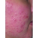 Spray Antiac, fata si corp,  pt. curatarea pielii congestionate cu acnee, Omega, vitamina A, E, Salcura 100 ml