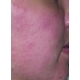 Spray Antiac, fata si corp,  pt. curatarea pielii congestionate cu acnee, Omega, vitamina A, E, Salcura 100 ml